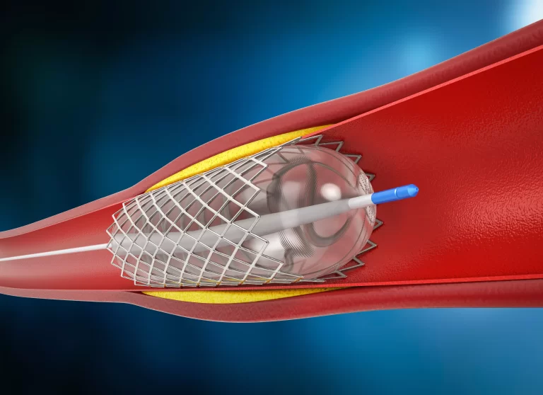 Representação médica de um stent cardíaco expandido dentro da artéria coronária, destacando a importância do procedimento e o direito à cobertura pelo plano de saúde.
