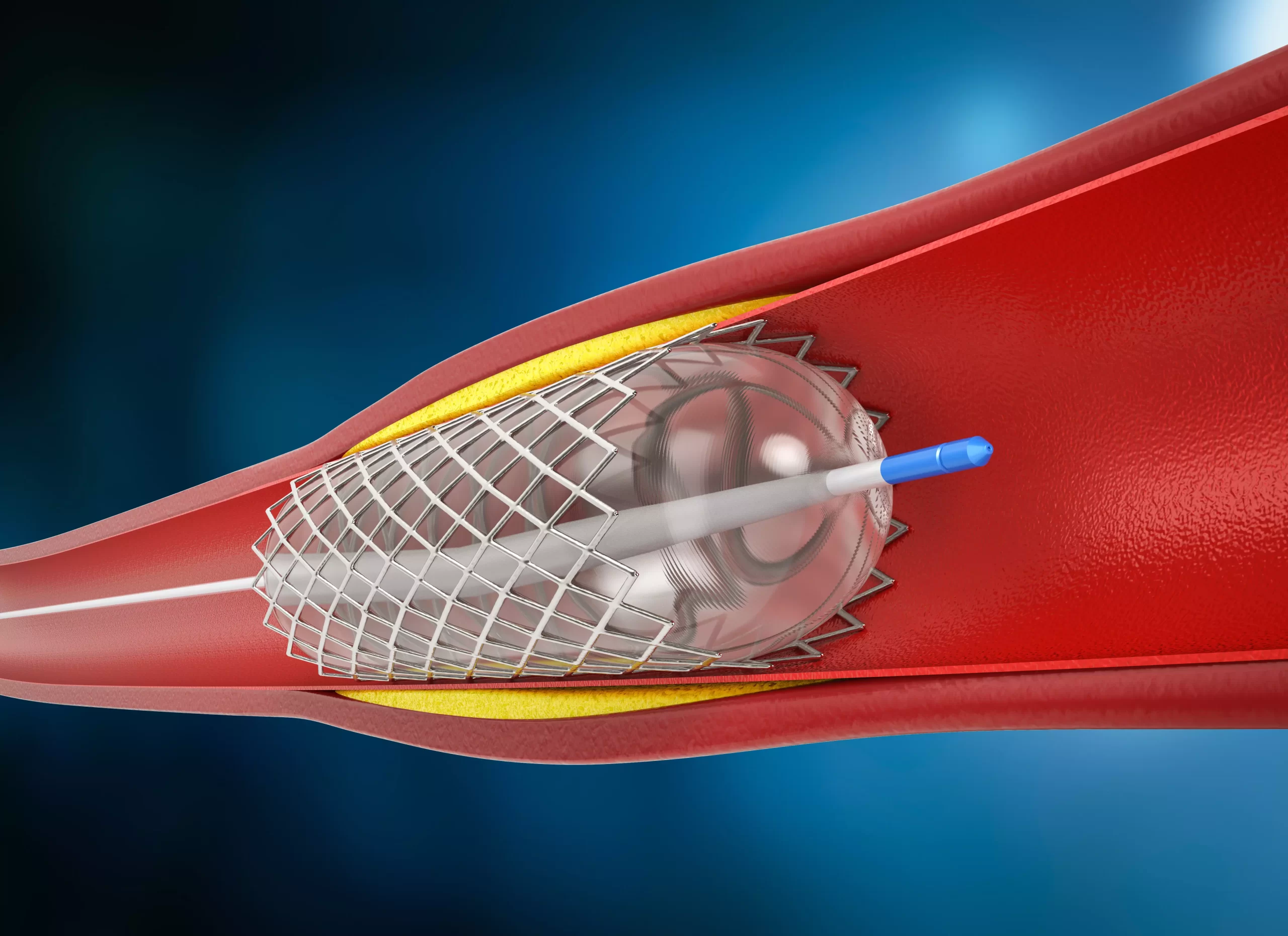 Representação médica de um stent cardíaco expandido dentro da artéria coronária, destacando a importância do procedimento e o direito à cobertura pelo plano de saúde.