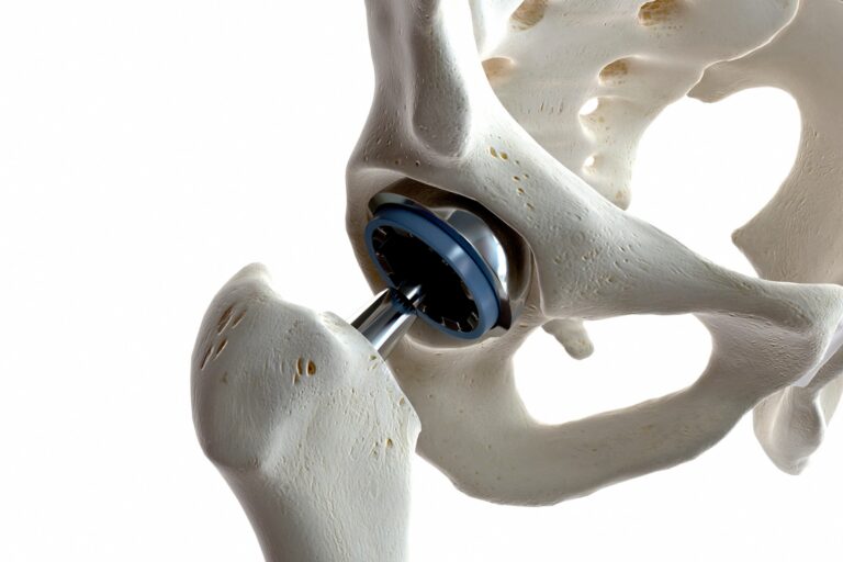 Representação da artroplastia total de quadril com prótese implantada, destacando o procedimento indicado em casos de osteoartrite e o direito à cobertura pelo plano de saúde.
