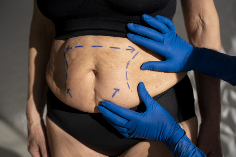 Cirurgião avaliando abdômen de paciente com marcações cirúrgicas, representando o direito à cirurgia plástica reparadora coberta pelo plano de saúde em casos de necessidade médica.