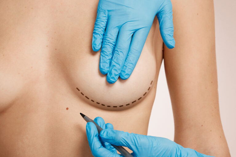 Paciente em avaliação médica para cirurgia de gigantoplastia, indicada para redução das mamas em casos de gigantomastia com cobertura pelo SUS ou plano de saúde.