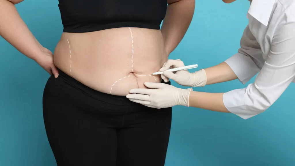Cirurgia Bariátrica negada pelo plano de saúde: o que fazer?