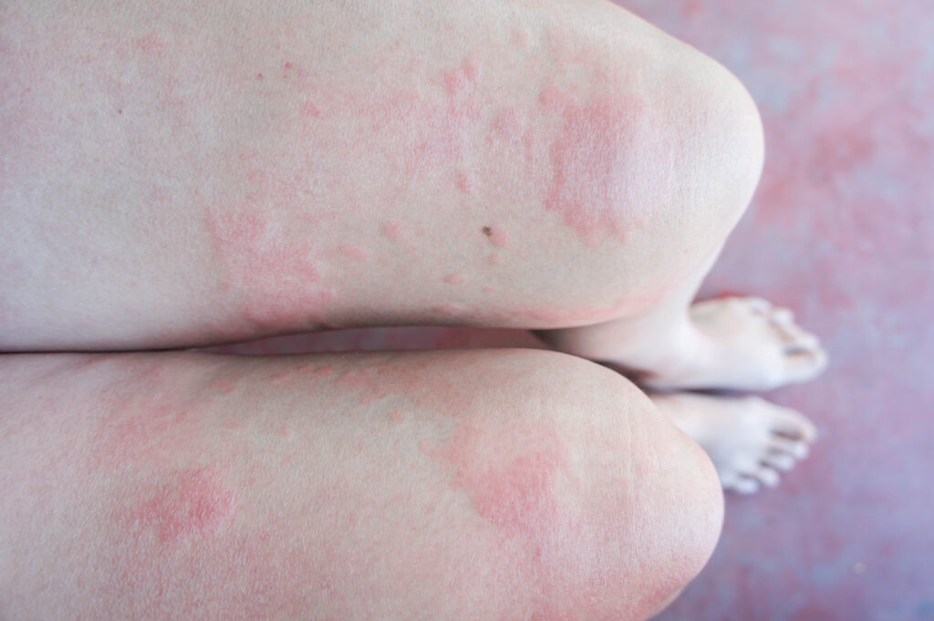 Paciente com urticária crônica e angioedema em consulta médica, mostrando lesões na pele e recebendo orientação para tratamento com omalizumabe.